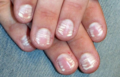 7 Reasons Why You Have White Spots On Your Nails Women Daily Magazine