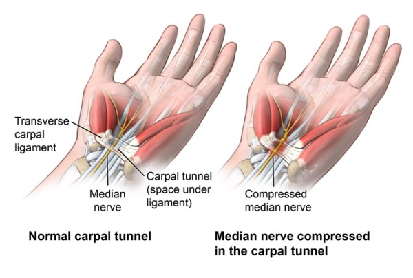 what-is-carpal-tunnel-syndrome-and-7-simple-homemade-remedies-that-will