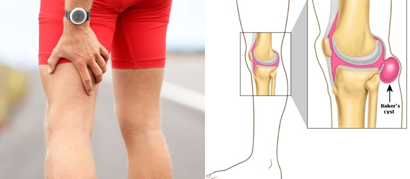 Do You Know What Causes Pain Behind The Knee And How To Deal With This 