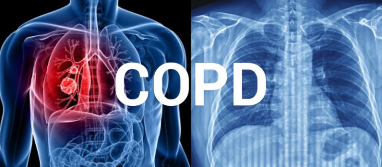 stem-cell-therapy-changing-copd-treatment - Women Daily Magazine