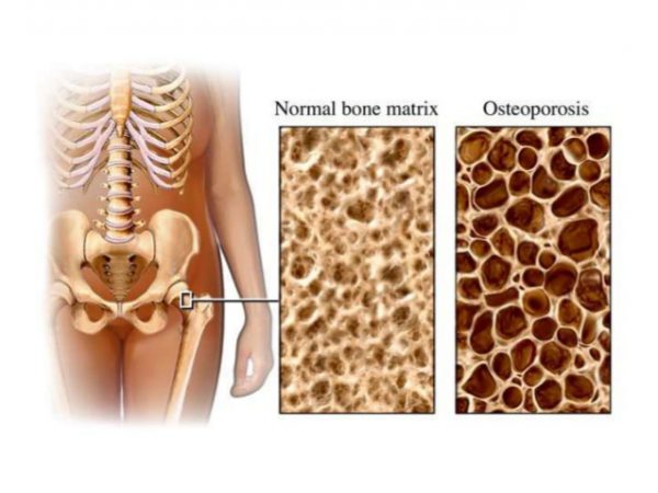 signs-and-symptoms-of-bone-cancer-women-daily-magazine