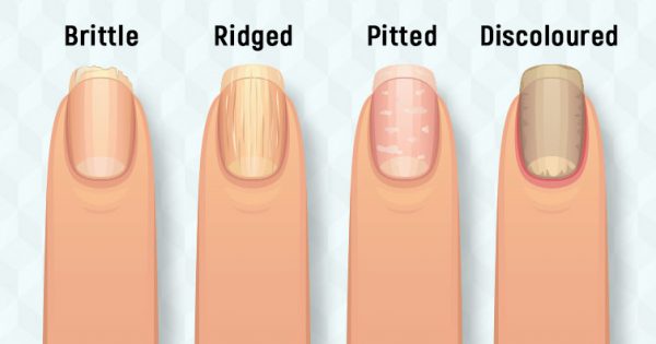 This is What Your Fingernails Are Warning You About: Organ Failure ...