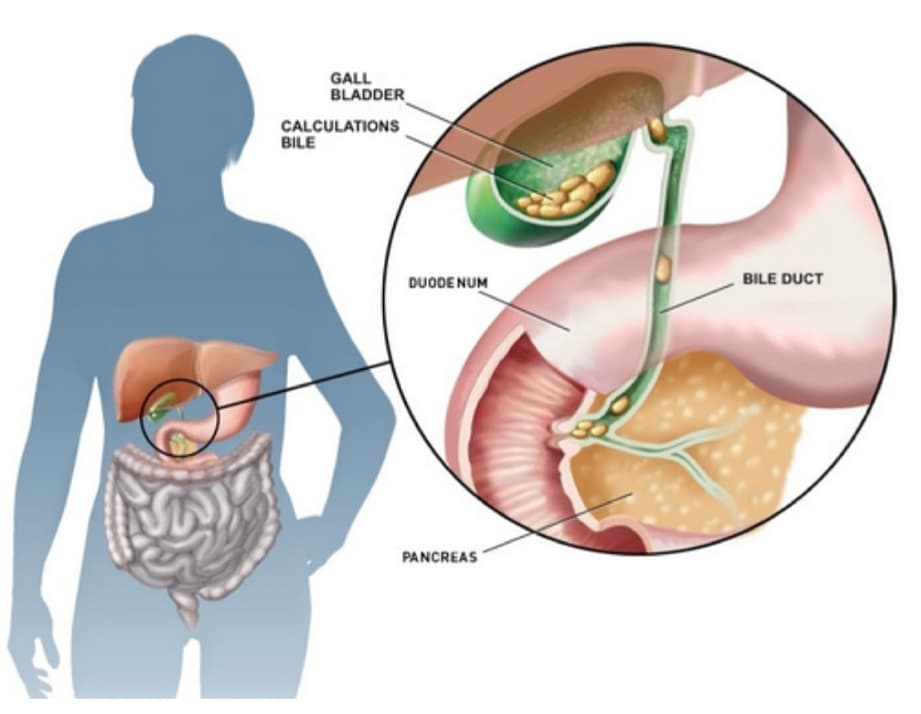 What Happens When Stone In Gallbladder