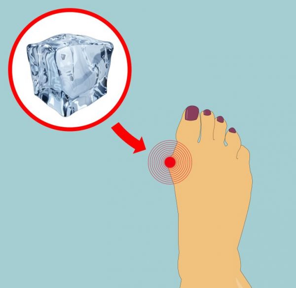 5 Ways To Naturally Shrink Your Bunions Without Surgery Women Daily