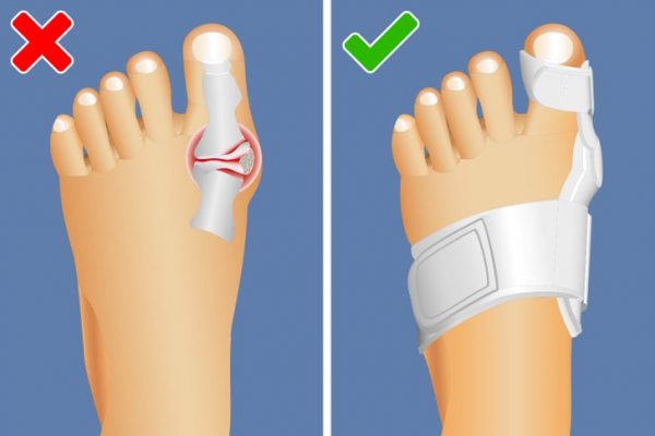 5 Ways To Naturally Shrink Your Bunions Without Surgery - Women Daily ...